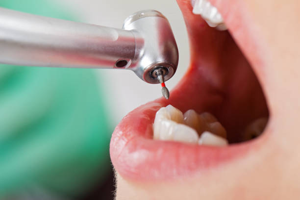 Best Urgent Care for Lost Fillings or Crowns in Gardena, CA